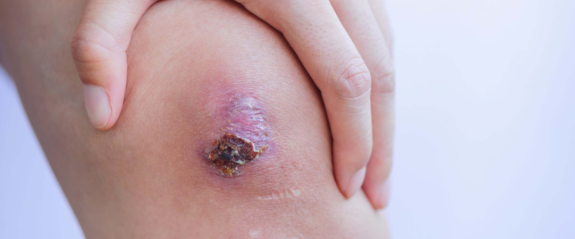 Innovative Techniques For Treating Slough Wound Tissue