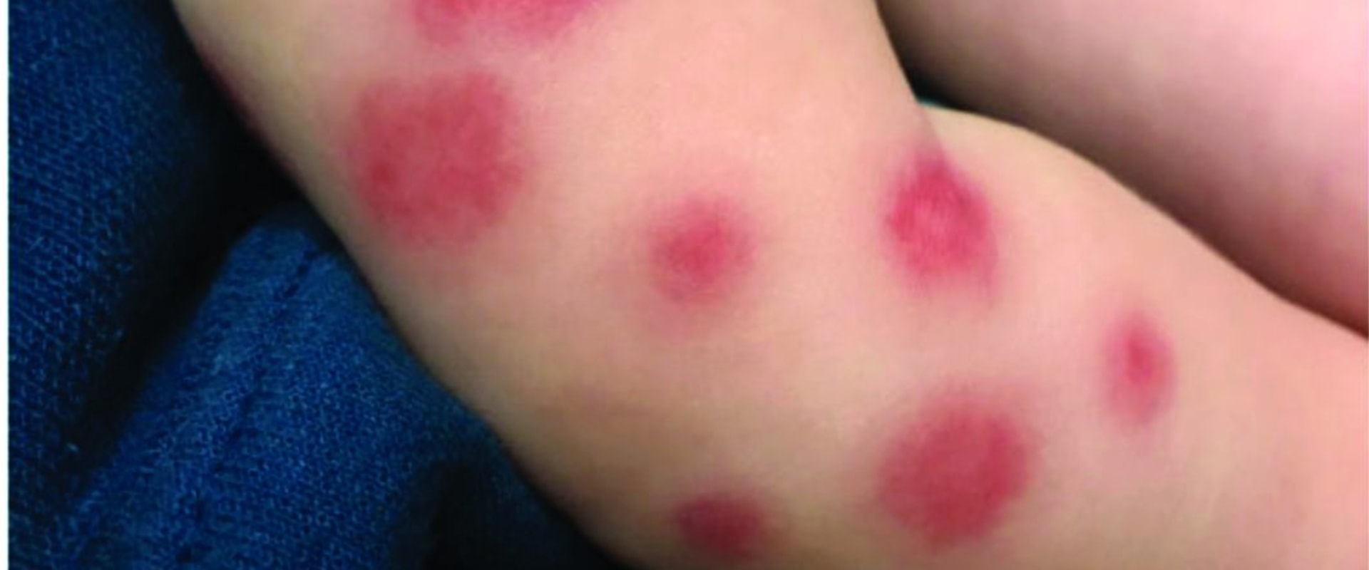 What Is Purpura Simplex on Rashes and Bruises A Guide That Reassures