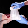 Is Serosanguineous Drainage Normal? Signs to Watch in Wound Care
