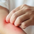 Is Itching a Sign of Healing? Everything You Need to Know About That Tingling Sensation After Injury