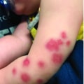 What Is Purpura Simplex on Rashes and Bruises A Guide That Reassures