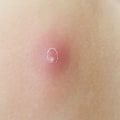 Boil vs Cyst vs Abscess: Causes, Symptoms & What to Do