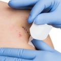 How Long Do Dissolvable Stitches Last? Expert Tips for Faster Healing