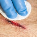 Infected Stitches? Learn the Signs & Speed Up Healing Today