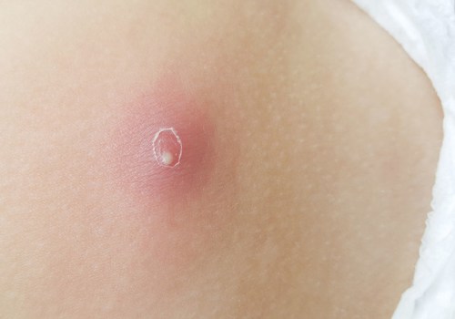 Boil vs Cyst vs Abscess: Causes, Symptoms & What to Do