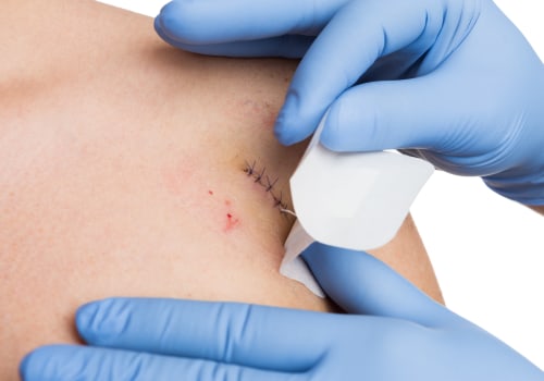 How Long Do Dissolvable Stitches Last? Expert Tips for Faster Healing