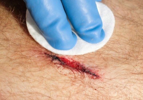 Infected Stitches? Learn the Signs & Speed Up Healing Today